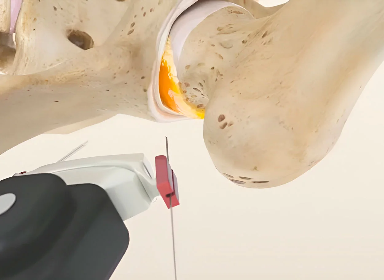 Necrosi avascolare della testa del femore — trattamento con il metodo MIBRAR®