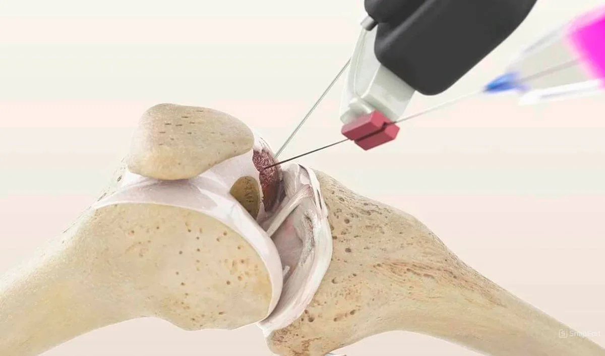 Leg Axis Deformity — treatment with MIBRAR® method
