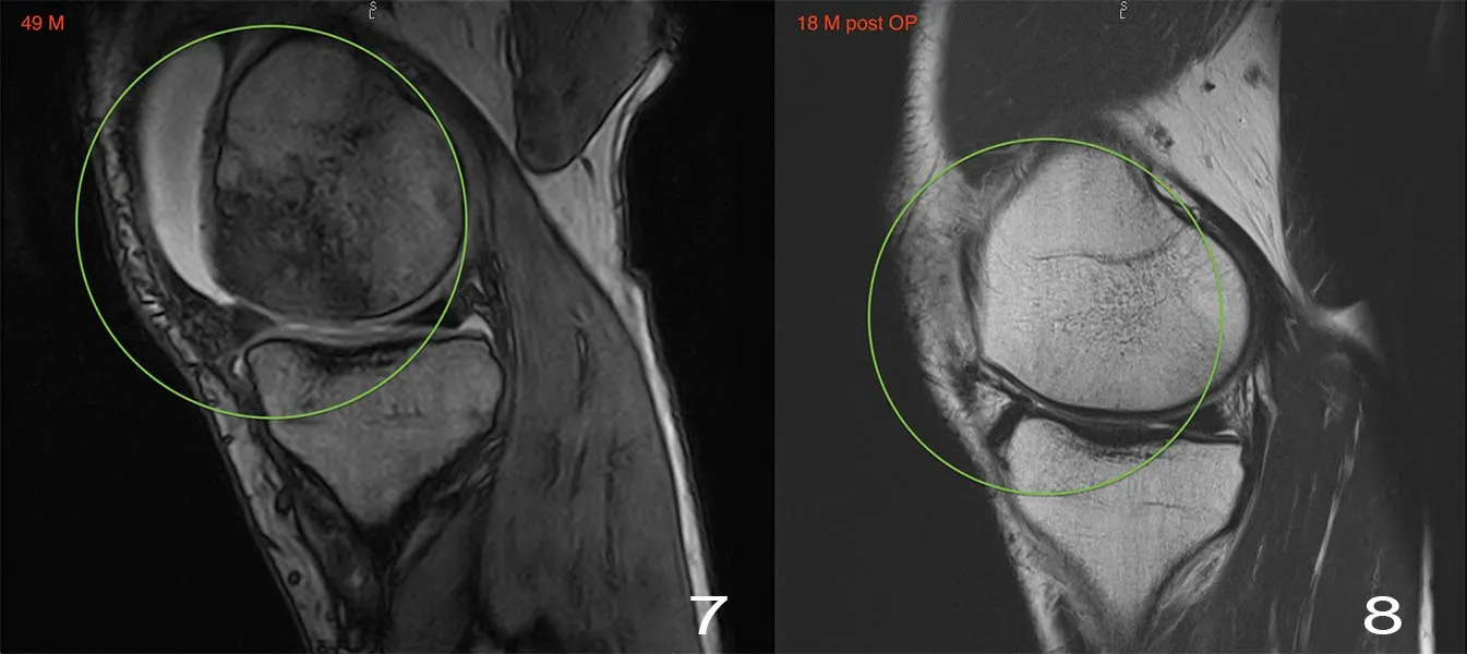 RM sagittale: rigenerazione della cartilagine condilare dopo MIBRAR® — prima e 18 mesi dopo, uomo 49 anni